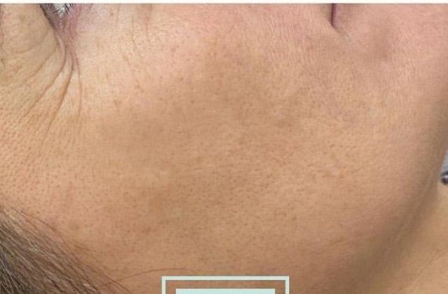 Apres photofacial IPL - teint unifie, Clinique F Montreal