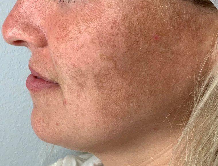 Avant photofacial IPL – taches pigmentaires et mélasma, Clinique F Montréal