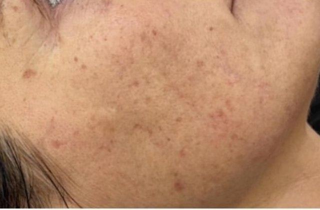 Avant photofacial IPL taches et rougeurs - Clinique F Montreal