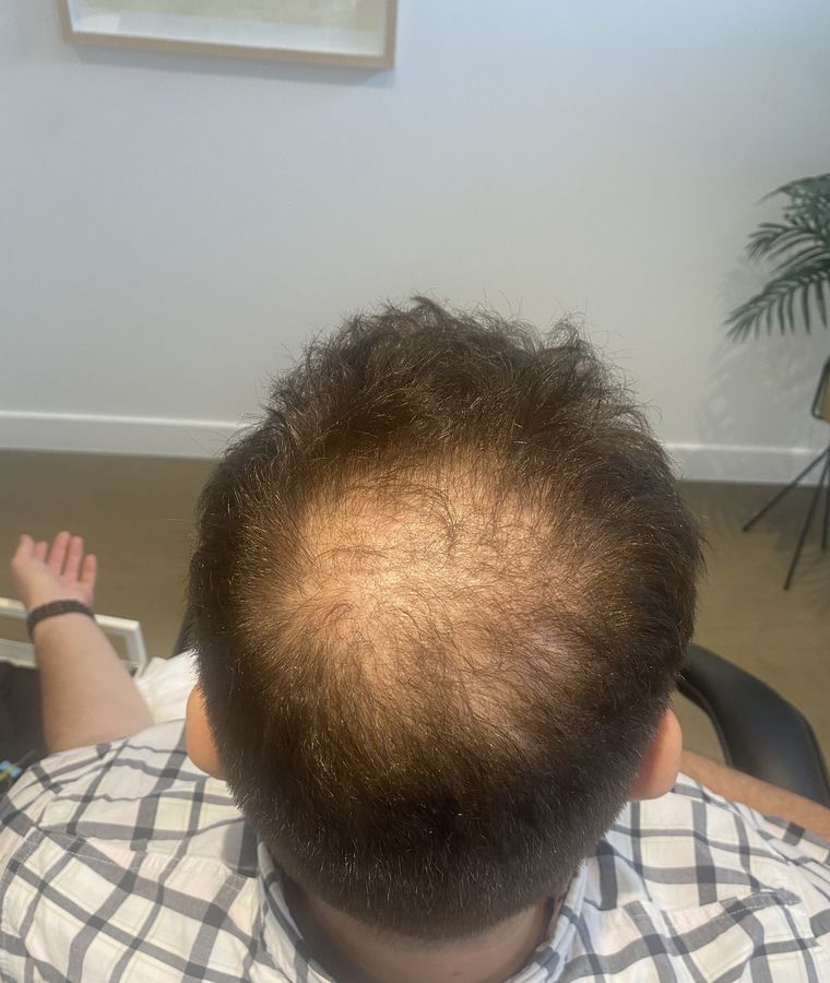 Avant PRP capillaire · Avant / Après - Clinique F Montreal