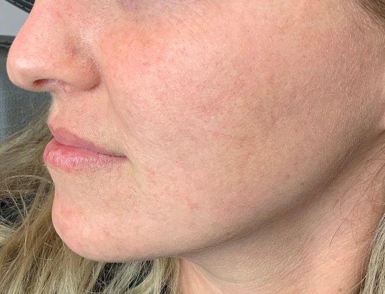 Après photofacial IPL – taches pigmentaires estompées, Clinique F Montréal